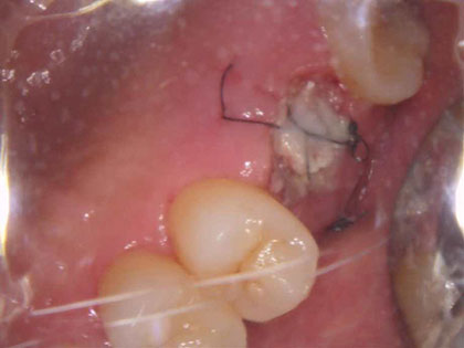 インプラント治療中1