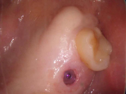 右上被せ物がとれたためインプラント治療を行った症例の画像