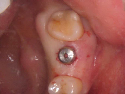 インプラント治療中3