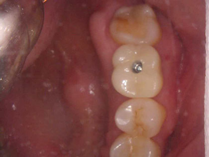 インプラント治療中4