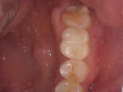 インプラント治療完了時1