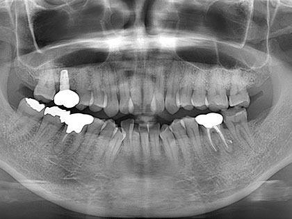 インプラント治療完了時2