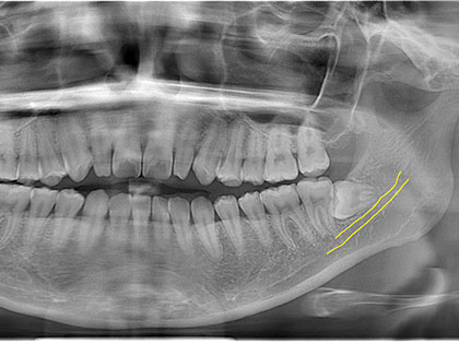 親知らず抜歯症例1