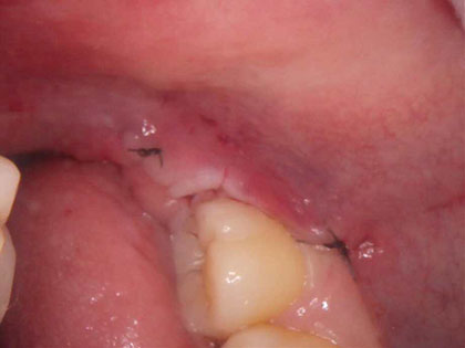 親知らずの抜歯治療中1