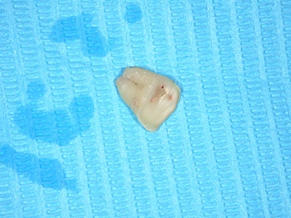 親知らずの抜歯治療中1