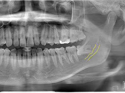 親知らず抜歯症例2