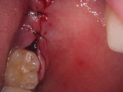 親知らずの抜歯治療中1