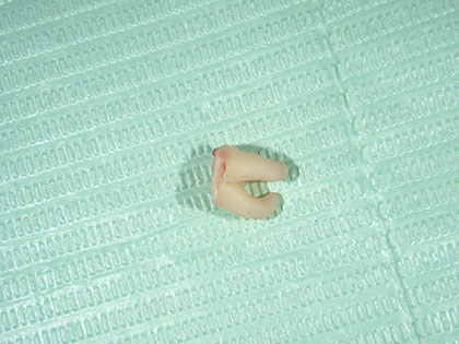 親知らずの抜歯治療中1