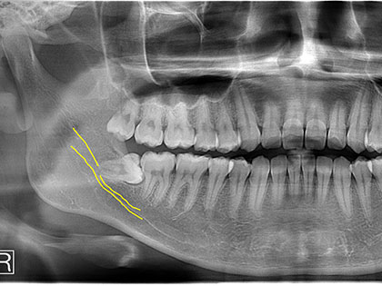 親知らず抜歯症例3