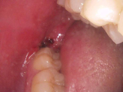 親知らずの抜歯治療中1