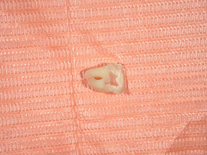 親知らずの抜歯治療中1