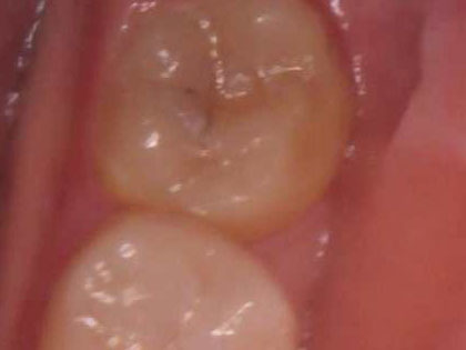 親知らずの抜歯治療中1