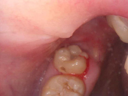 親知らずの抜歯治療中2