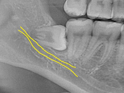 親知らず抜歯症例5
