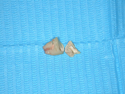 親知らずの抜歯治療中1