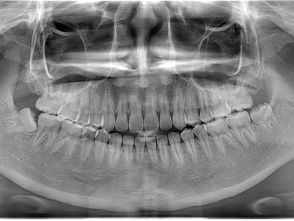 親知らず抜歯症例6