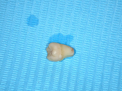 抜歯した親知らず4