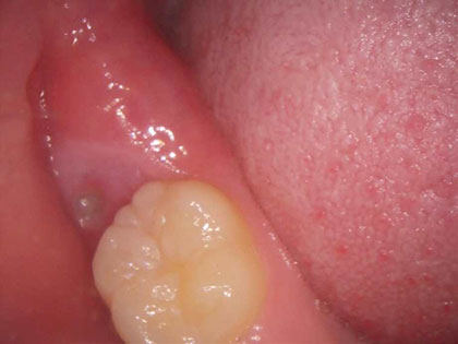 親知らずの抜歯術前2