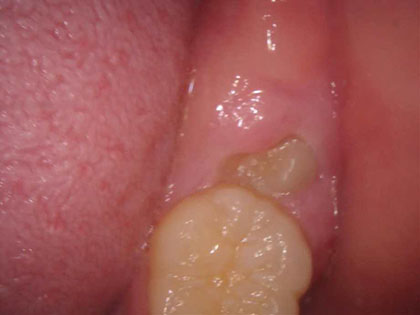 親知らずの抜歯術前3