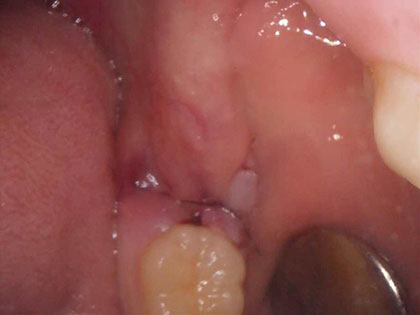 親知らずの抜歯治療中1