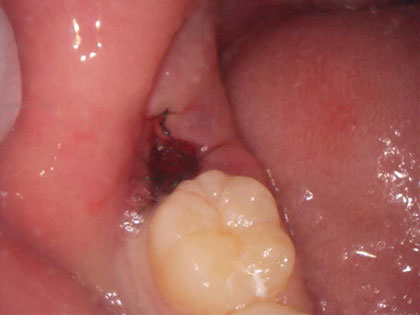 親知らずの抜歯治療中4