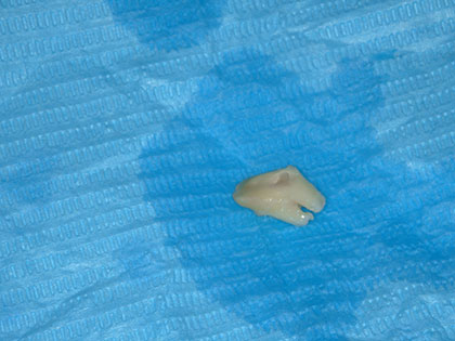 抜歯した親知らず2