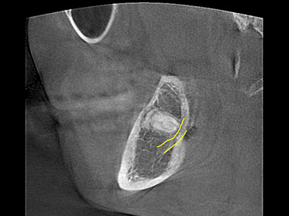 親知らずの抜歯術前1