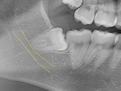 親知らず抜歯症例7