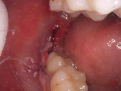 親知らずの抜歯治療中1