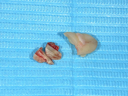 抜歯した親知らず1