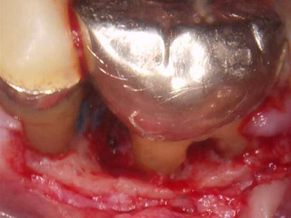 ジルコニアインレー治療中1
