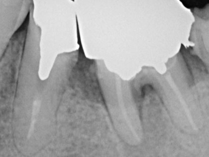 リグロスの術前2