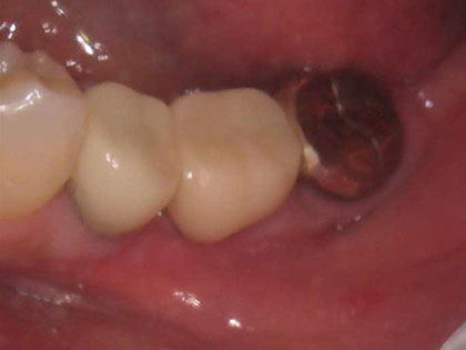 リグロスの術後1