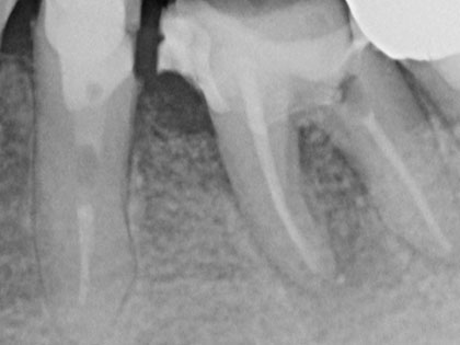 何度も腫れや痛みを繰り返してきたとの事で来院された患者様の症例の画像